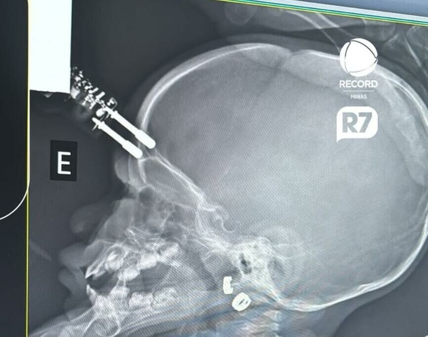 Imagem de compartilhamento para o artigo Bebê cai da cama e fica com pino de carregador cravado na testa em Minas Gerais da MS Todo dia